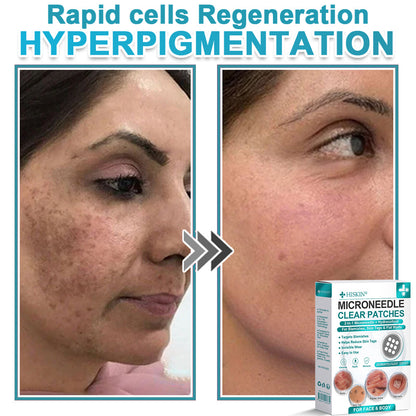 ✨Hiskin ® 2-in-1 Microneedle & Hydrocolloid Patch🍀 | Removes raised moles, acne, flat warts, and skin tags | Helps improve wrinkles, scars, and blemishes | Invisible patches for face and body