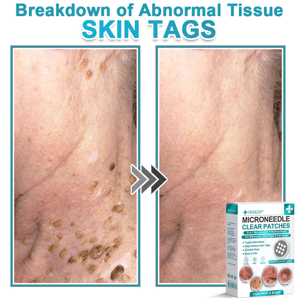 ✨Hiskin ® 2-in-1 Microneedle & Hydrocolloid Patch🍀 | Removes raised moles, acne, flat warts, and skin tags | Helps improve wrinkles, scars, and blemishes | Invisible patches for face and body