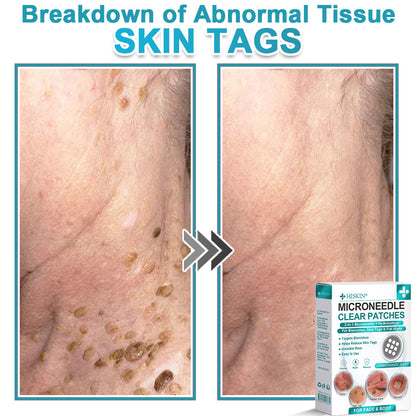 ✨Hiskin ® 2-in-1 Microneedle & Hydrocolloid Patch🍀 | Removes raised moles, acne, flat warts, and skin tags | Helps improve wrinkles, scars, and blemishes | Invisible patches for face and body