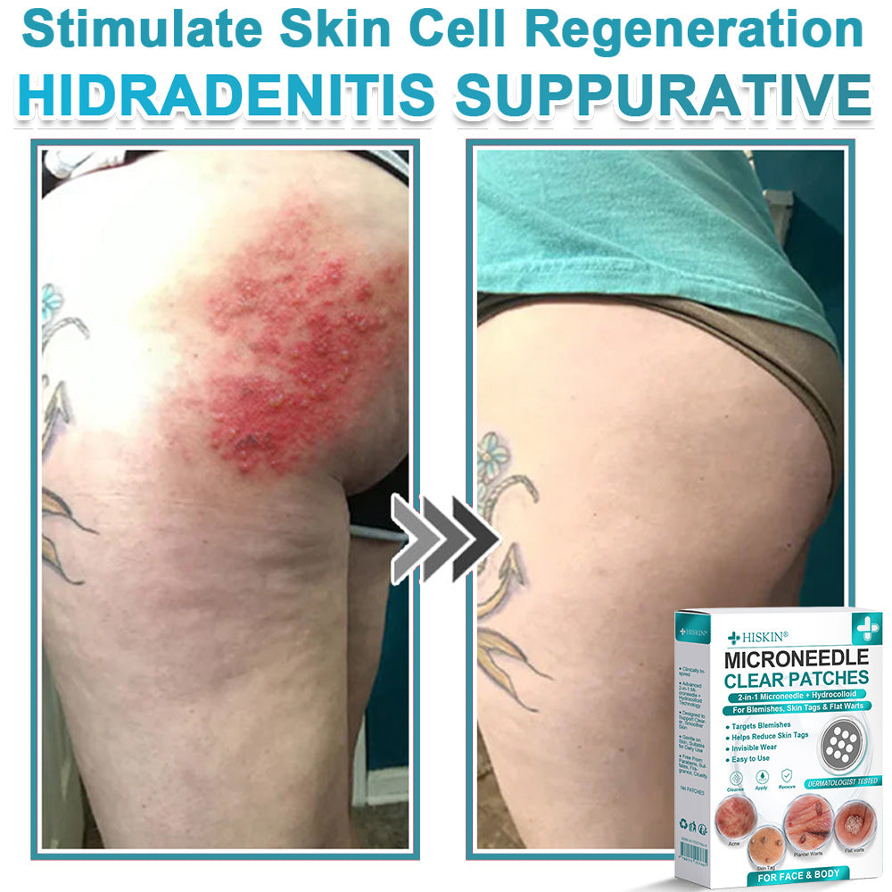 ✨Hiskin ® 2-in-1 Microneedle & Hydrocolloid Patch🍀 | Removes raised moles, acne, flat warts, and skin tags | Helps improve wrinkles, scars, and blemishes | Invisible patches for face and body
