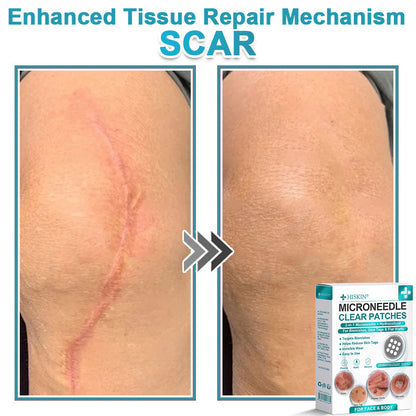 ✨Hiskin ® 2-in-1 Microneedle & Hydrocolloid Patch🍀 | Removes raised moles, acne, flat warts, and skin tags | Helps improve wrinkles, scars, and blemishes | Invisible patches for face and body