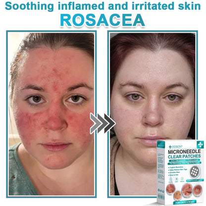 ✨Hiskin ® 2-in-1 Microneedle & Hydrocolloid Patch🍀 | Removes raised moles, acne, flat warts, and skin tags | Helps improve wrinkles, scars, and blemishes | Invisible patches for face and body