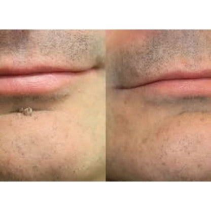 Hiskin ® 2-in-1 Microneedle & Hydrocolloid Patch🍀 | Removes raised moles, acne, flat warts, and skin tags | Helps improve wrinkles, scars, and blemishes | Invisible patches for face and body