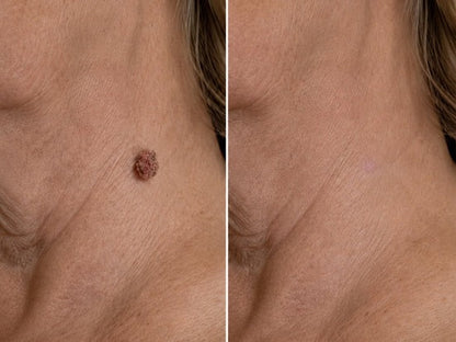 Hiskin ® 2-in-1 Microneedle & Hydrocolloid Patch🍀 | Removes raised moles, acne, flat warts, and skin tags | Helps improve wrinkles, scars, and blemishes | Invisible patches for face and body